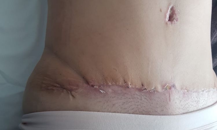 30 días post operatorio de abdominoplastia tengo pliegues - 15565