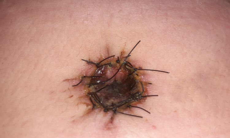 Dermolipectomia hace 8 dias y mi ombligo tomo un color oscuro - 15782