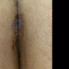 Tengo dos meses que me hice una gluteoplastia y aun no me cierra la herida
