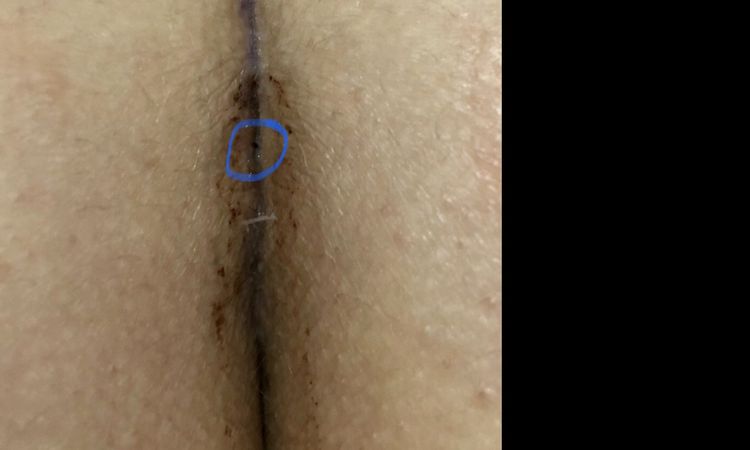 Tengo dos meses que me hice una gluteoplastia y aun no me cierra la herida - 16030
