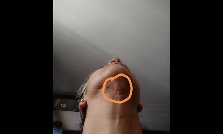 Corticoide inyectable en lipopapada - 16248