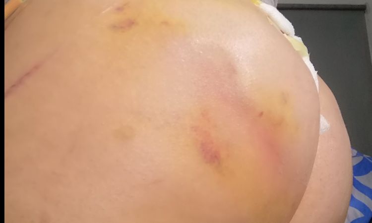 Me hice una glúteoplastia llevo 15 días pero un glúteo lo siento caliente - 16263