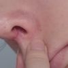 ¿Rinoplastia secundaria para quitar una cicatriz gruesa en fosa nasal? - 16644