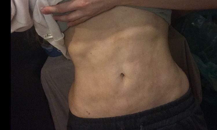 ¿Cómo tratar fibrosis después de lipoescultura? - 16680