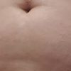 Puedo hacer una lipo sin que me quede la piel suelta?