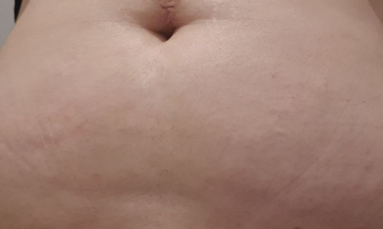 Puedo hacer una lipo sin que me quede la piel suelta? - 44434