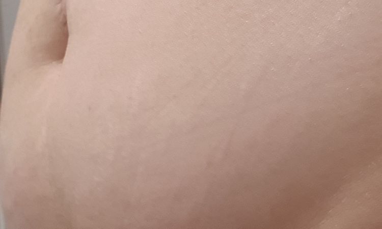 Puedo hacer una lipo sin que me quede la piel suelta? - 44435