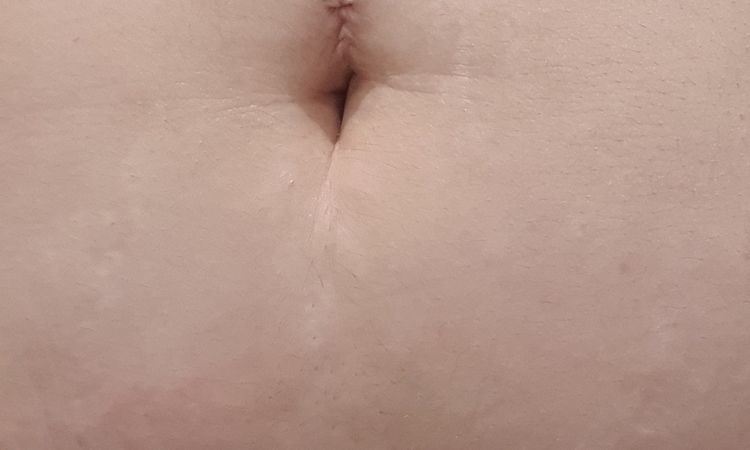 Puedo hacer una lipo sin que me quede la piel suelta? - 44436