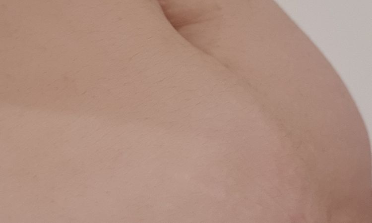 Puedo hacer una lipo sin que me quede la piel suelta? - 44437