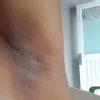 Tratamiento efectivo para la acantosis