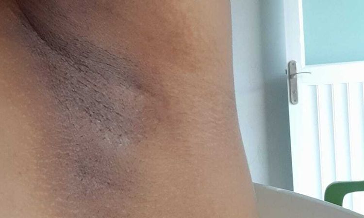 Tratamiento efectivo para la acantosis - 44698