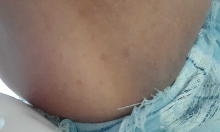 Tratamiento efectivo para la acantosis - 44699