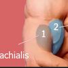 Cirugía reconstructiva del músculo brachialis y/o vasto interno