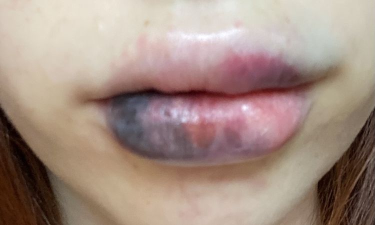 Labios muy morados ácido hialuronico - 47055