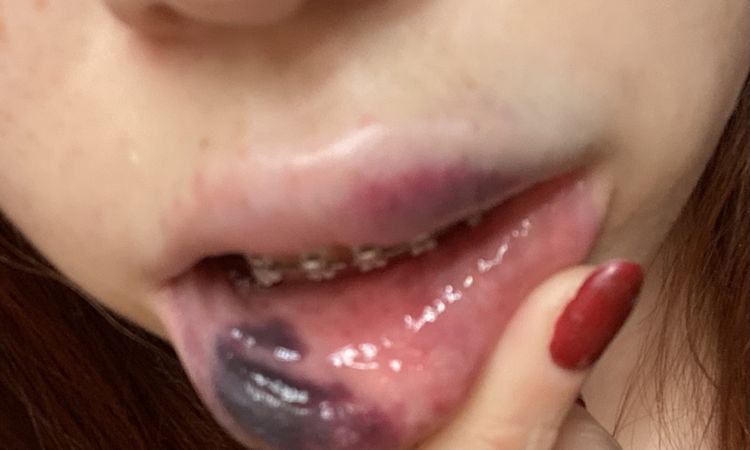 Labios muy morados ácido hialuronico - 47056