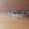 Curas y Cicatrización de herida que arde post mamoplastia