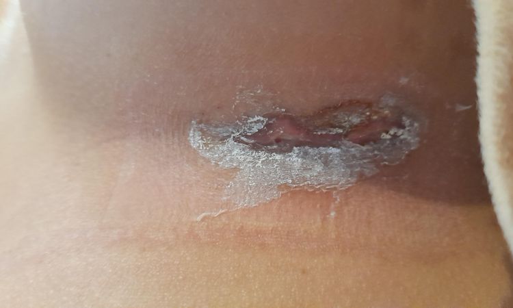 Curas y Cicatrización de herida que arde post mamoplastia - 47437
