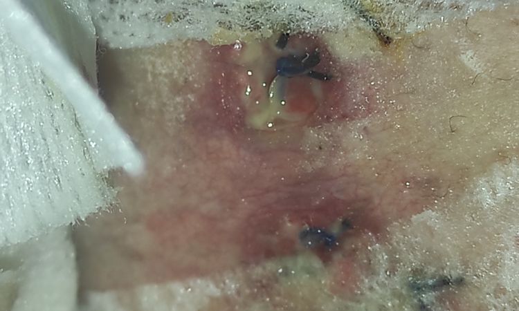 Heridas muy feas en mastopexia después de 2 meses - 47640