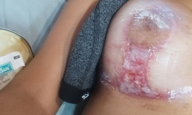 Heridas muy feas en mastopexia después de 2 meses - 47641