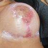 Heridas muy feas en mastopexia después de 2 meses