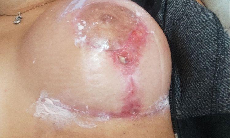 Heridas muy feas en mastopexia después de 2 meses - 47642