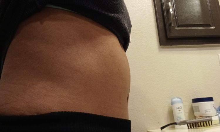 Sensibilidad y ardor después de 3 meses y medio de abdominoplastia - 48407
