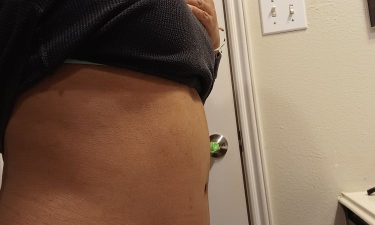 Sensibilidad y ardor después de 3 meses y medio de abdominoplastia - 48408