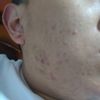 Solución a mi problema de acné que no mejora con doxiciclina - 49149