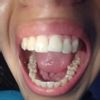 Cirugía para tratar cara torcida por dentadura