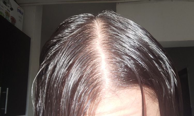 Cómo sé si tengo alopecia? - 50454