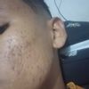 Eliminar las cicatrices que me dejó el acné con láser precioso - 50858