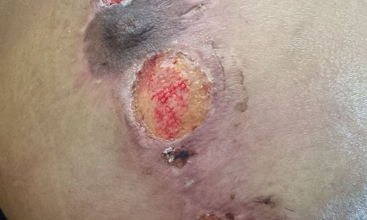 Pioderma o alergia?  Quisiera saber como puedo tener un diagnóstico - 51049