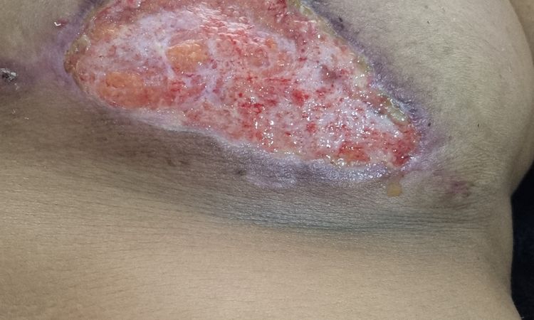 Pioderma o alergia?  Quisiera saber como puedo tener un diagnóstico - 51050