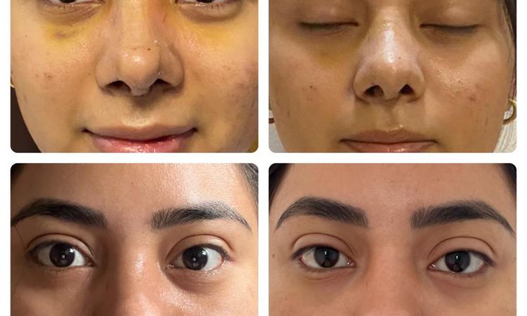 Asimetría en fosas o retracción post rinoplastia? - 51202