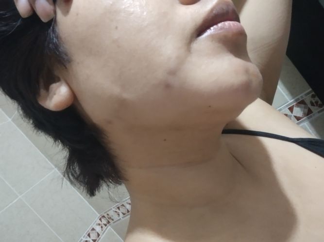 Fibrosis post lipopapada y bichectomía