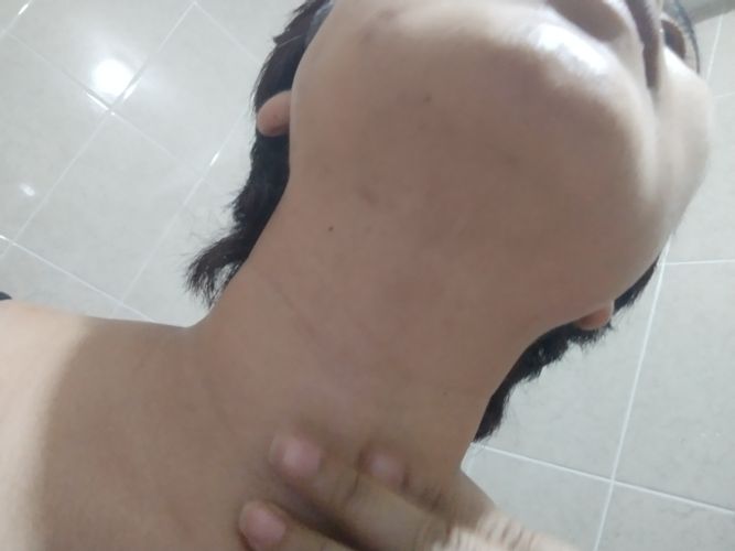 Fibrosis post lipopapada y bichectomía