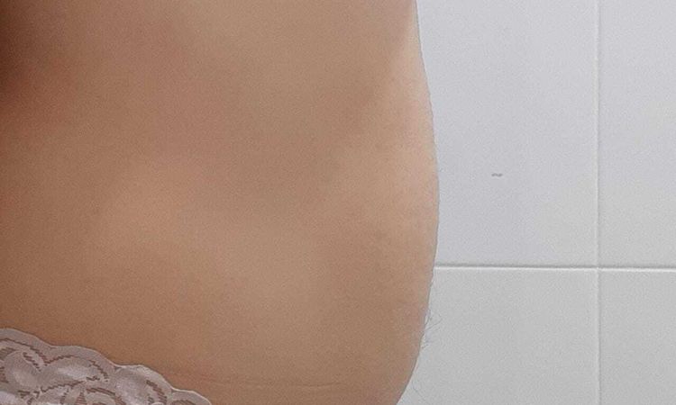 Soy candidata para lipólisis Láser? - 51758
