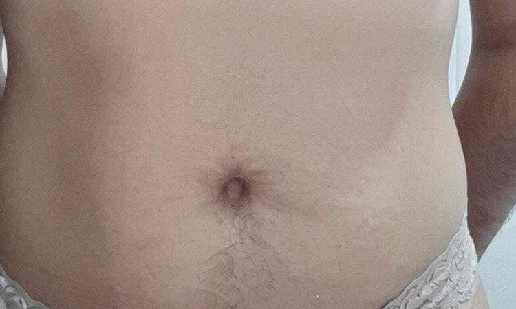 Soy candidata para lipólisis Láser? - 51759