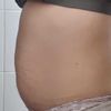 Soy candidata para lipólisis Láser?