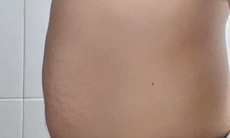 Soy candidata para lipólisis Láser? - 51760