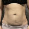 Quisiera saber si soy candidata para mini abdominoplastia
