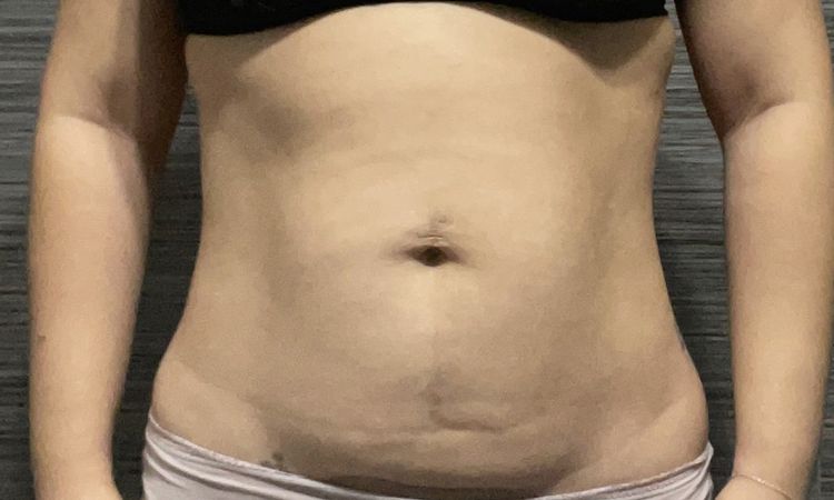 Quisiera saber si soy candidata para mini abdominoplastia - 51823