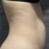 Quisiera saber si soy candidata para mini abdominoplastia