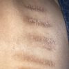 ¿Cuál es el mejor tratamiento para eliminar cicatrices por cortes de cuchilla?
