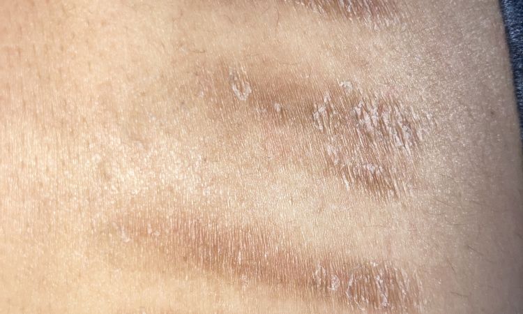 ¿Cuál es el mejor tratamiento para eliminar cicatrices por cortes de cuchilla? - 52863