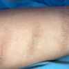 ¿Cuál es el mejor tratamiento para eliminar cicatrices por cortes de cuchilla?