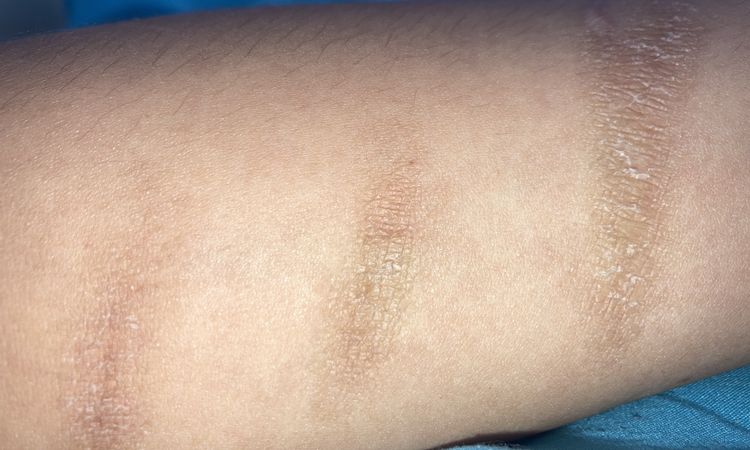¿Cuál es el mejor tratamiento para eliminar cicatrices por cortes de cuchilla? - 52864