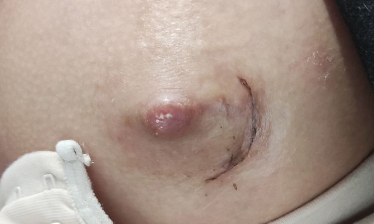 Están evolucionando bien las cicatrices de mis areolas? - 54075