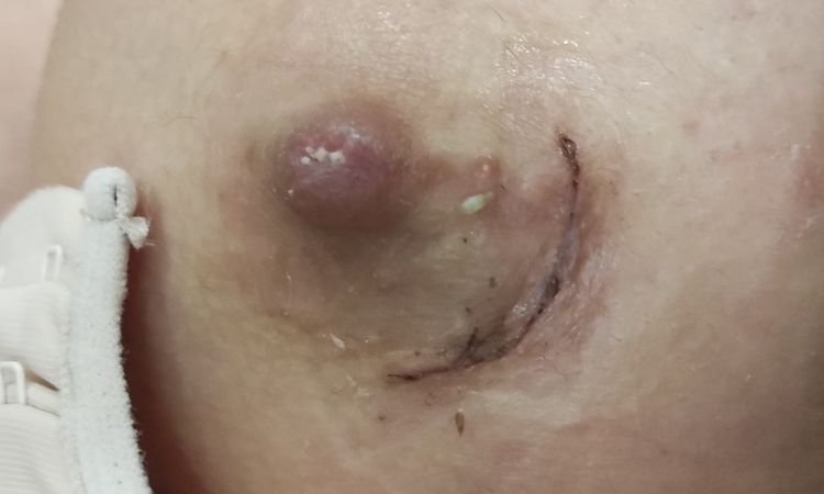 Están evolucionando bien las cicatrices de mis areolas? - 54076