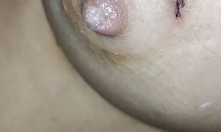Están evolucionando bien las cicatrices de mis areolas? - 54077